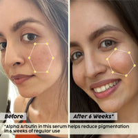 Plix 2% Alpha Arbutin Pineapple Serum for Pigmentation & Dark Spot Reduction (30ml)